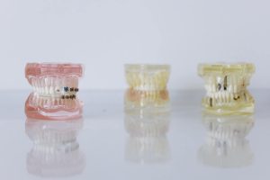 Czym się różni invisalign od clear aligner