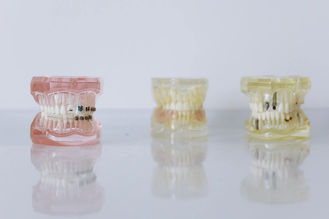 Czym się różni invisalign od clear aligner