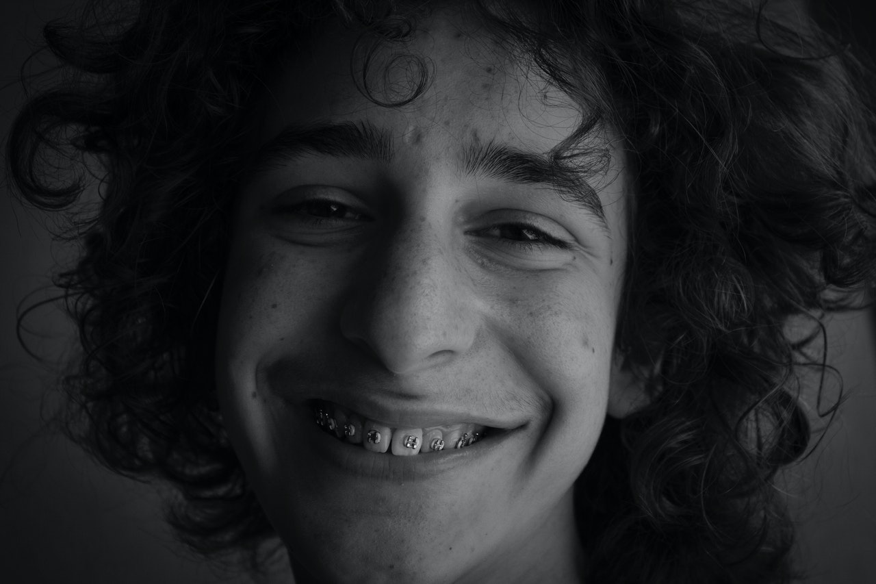 Krzywe zęby po aparacie stałym